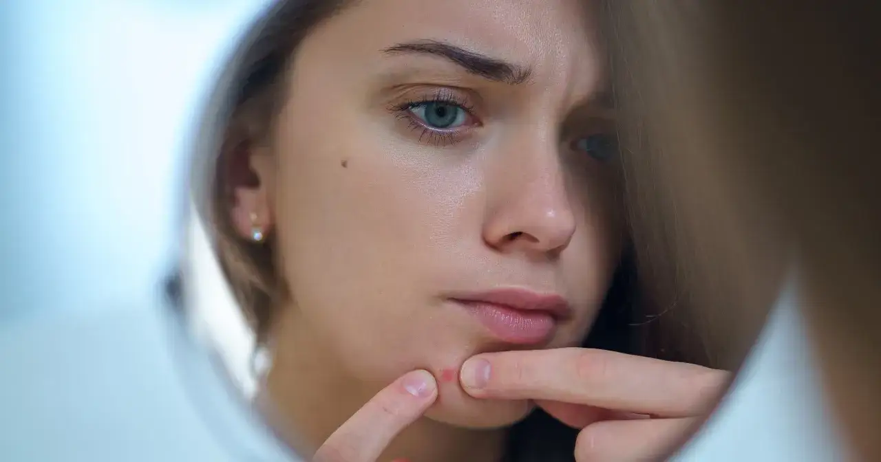 Jak wyciskać pryszcze bezpiecznie? Ekspert radzi!