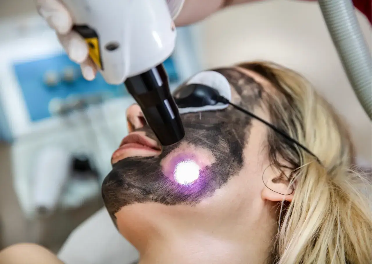 Zabieg laserowy peeling węglowy przed i po. Skóra twarzy pokryta maską węglową, na którą skierowany jest promień lasera.