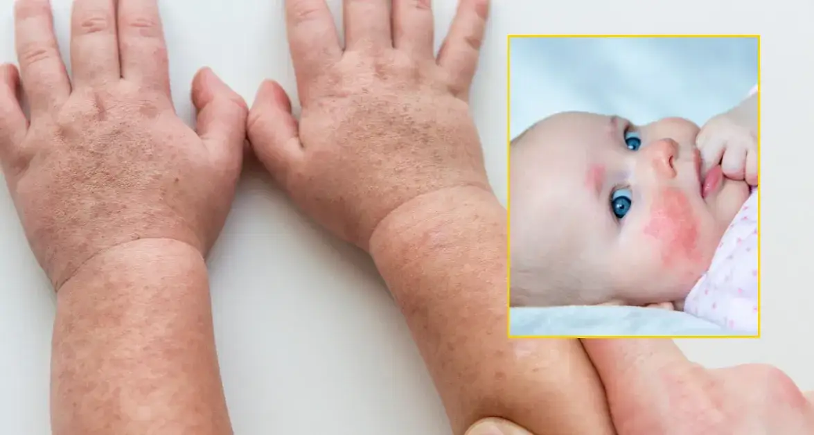 Objawy szkarlatyny u dzieci: jak je rozpoznać i kiedy działać