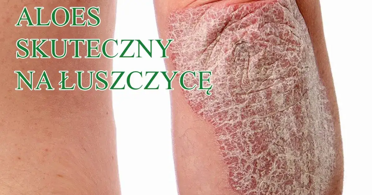 Czy jest nowy lek na łuszczycę? Odkryj najnowsze terapie i ich skuteczność