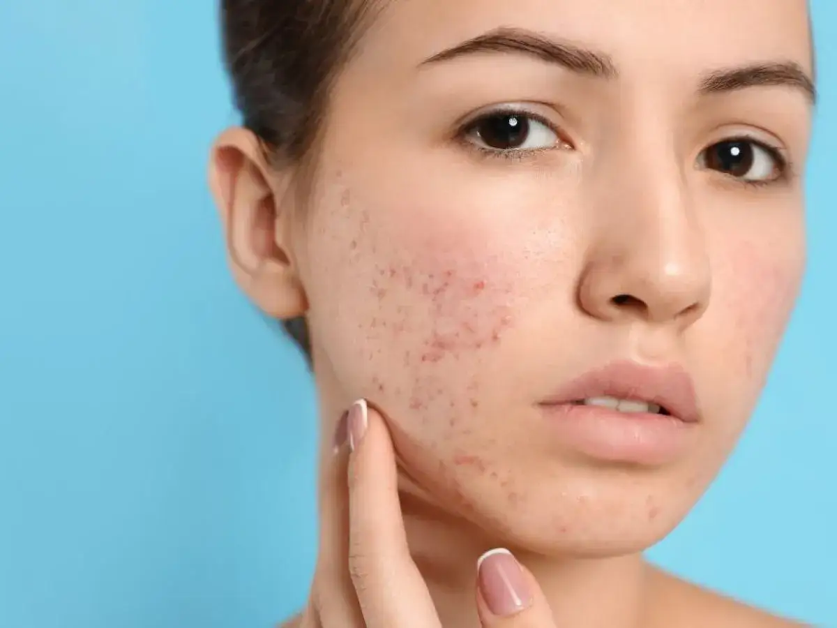 Cera trądzikowa: Kompletny poradnik. Co działa, a co szkodzi?