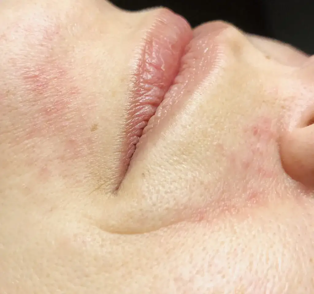 Raue Gesichtshaut: Ursachen und effektive Tipps zur Verbesserung