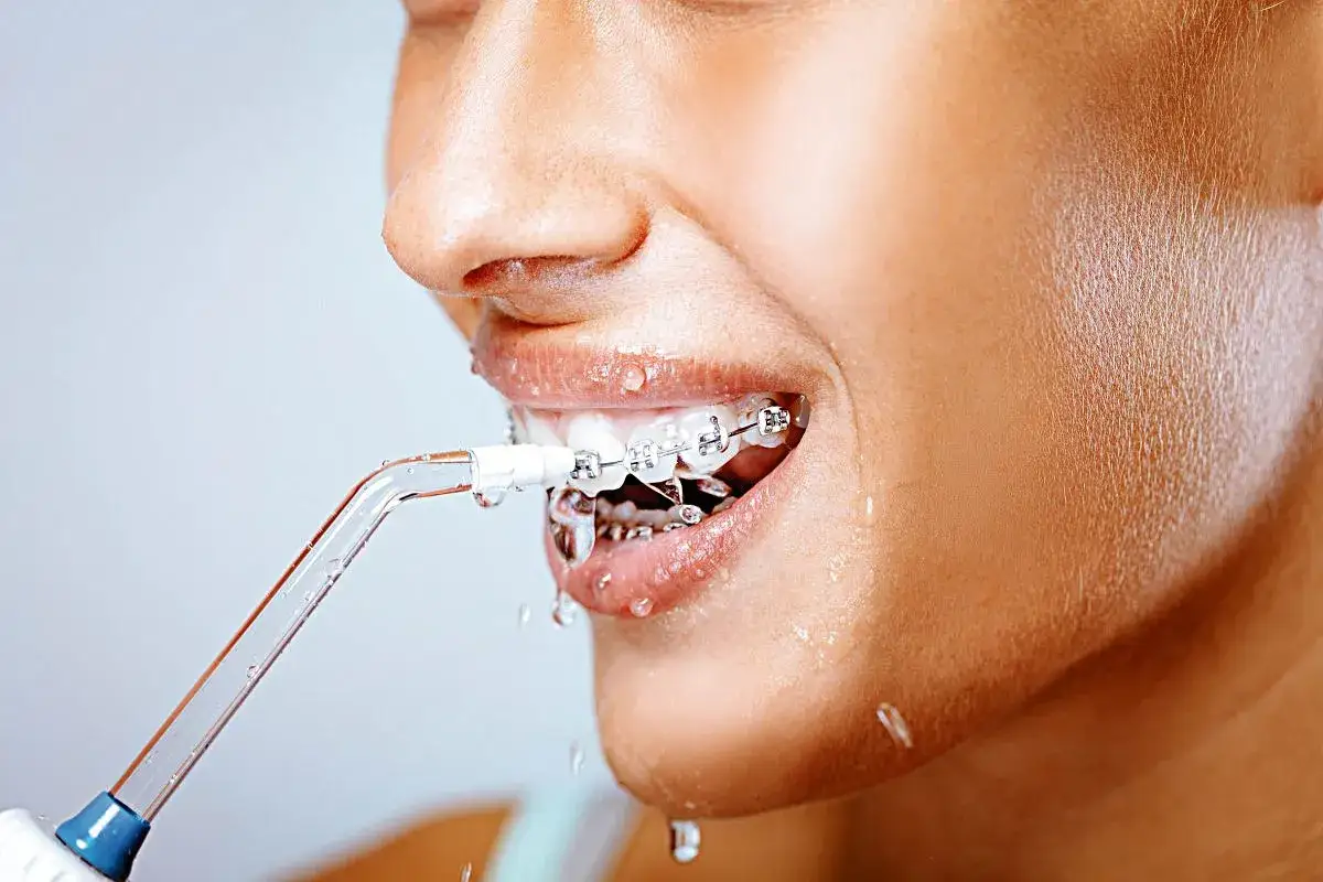 Irygator skutecznie usuwa kamień nazębny, zwłaszcza wokół aparatu ortodontycznego. Woda rozpryskuje się, docierając do trudno dostępnych miejsc.