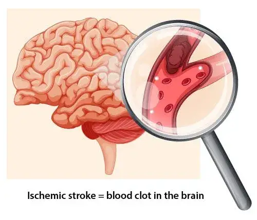 Mini udar – objawy, leczenie i jak uniknąć poważnych konsekwencji