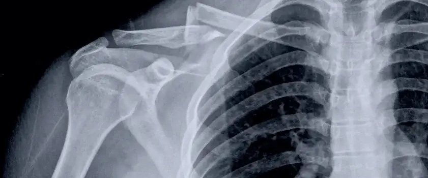 Złamany obojczyk - Wskazania do operacji i przebieg leczenia