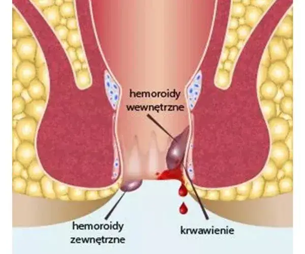 Czy chirurg leczy hemoroidy? Poznaj skuteczne metody leczenia