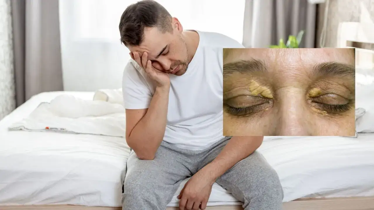 Podwyższony cholesterol objawy: jak je rozpoznać i co robić?