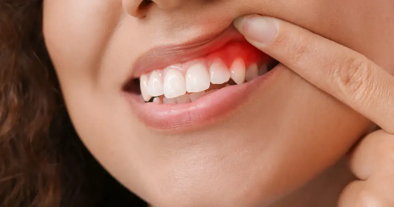 Krwawienie dziąseł: sygnał, którego nie możesz ignorować. Co robić?