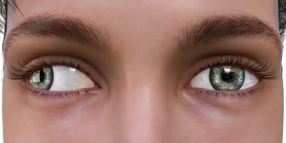 Zez: Czy da się wyleczyć? Skuteczne metody i szanse na proste oczy