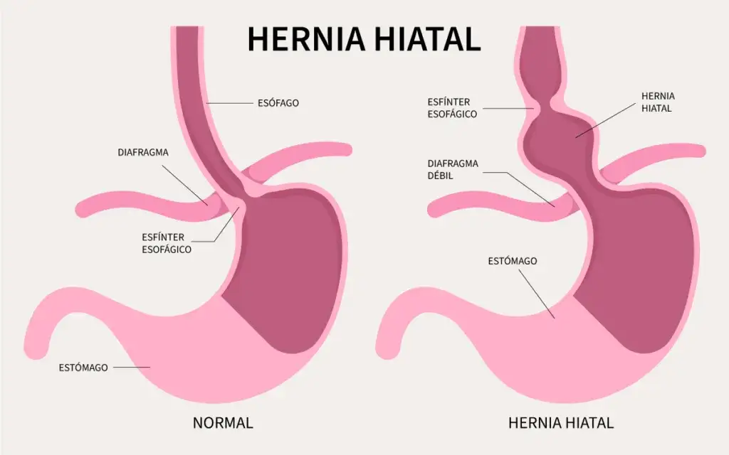 Hernia de hiato: Identifica sus síntomas y cuándo buscar ayuda.