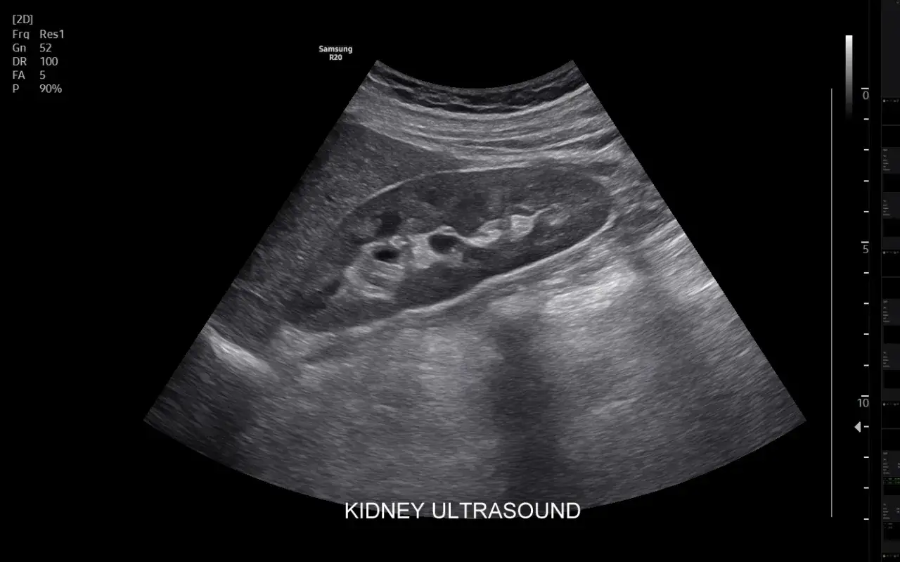 Obraz USG nerki. Czy usg jamy brzusznej wykryje raka? Badanie pokazuje strukturę nerki, pomagając w diagnostyce.