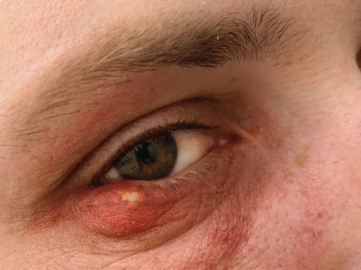 Oko z zaczerwienioną powieką i widocznymi żółtymi plamami pod oczami, wskazującymi na stan zapalny.