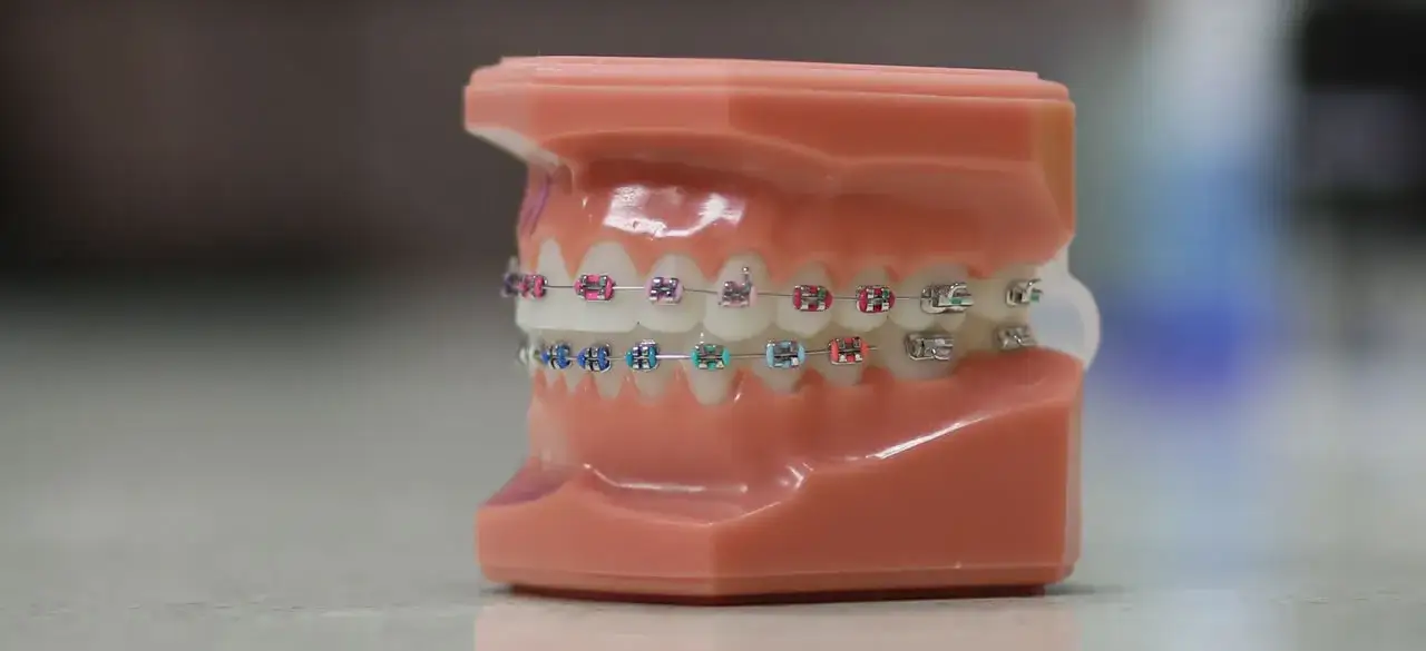 Jak przyciąć drut od aparatu ortodontycznego bez ryzyka uszkodzenia