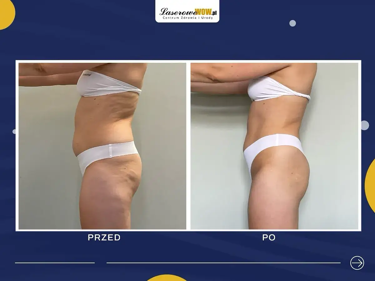 Liposukcja: Modelowanie sylwetki czy odchudzanie? Poznaj prawdę