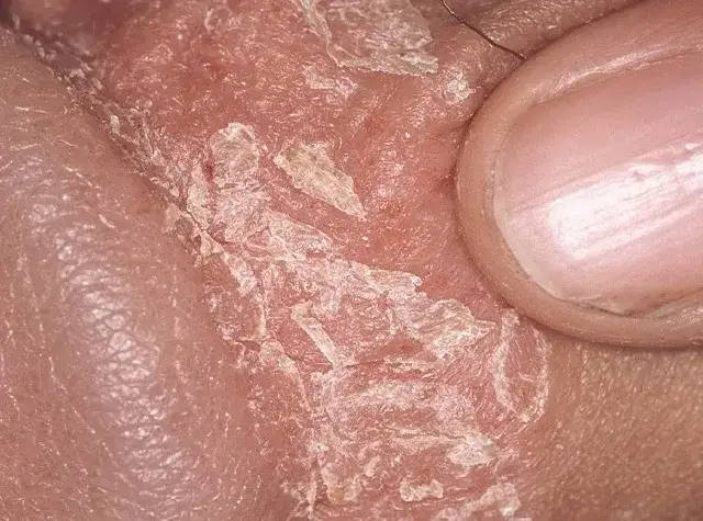 Zmiany skórne na prąciu? Sprawdź, do jakiego lekarza iść!