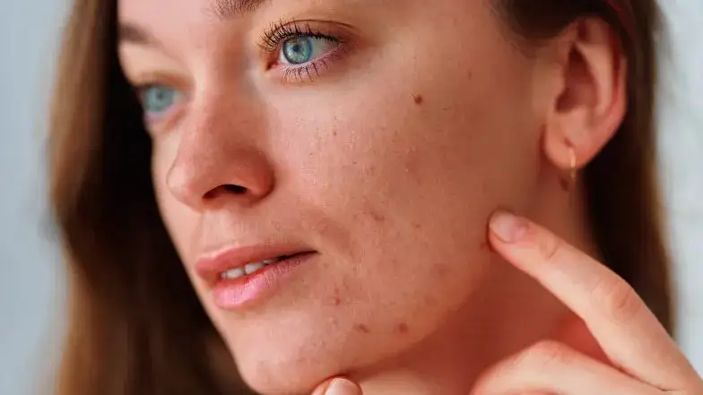 Jak poprawić cerę trądzikową? Skuteczny poradnik krok po kroku