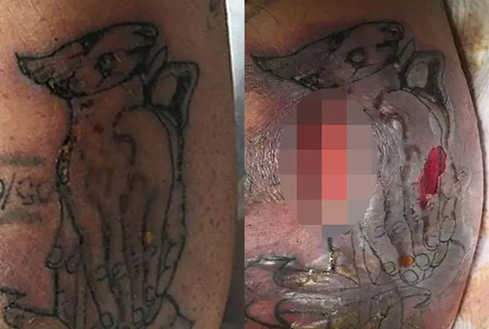 Ropa na tatuażu: Kiedy się niepokoić? Objawy infekcji