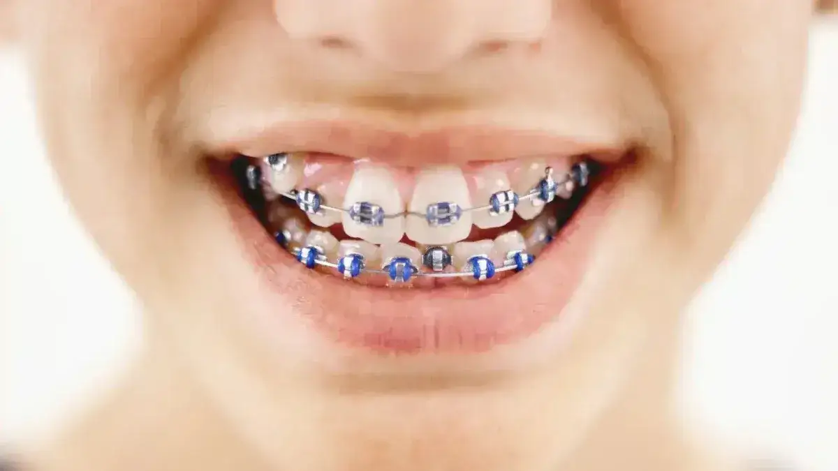 Kiedy aparat stały dla dziecka? Ortodonta radzi: wiek, koszty, proces