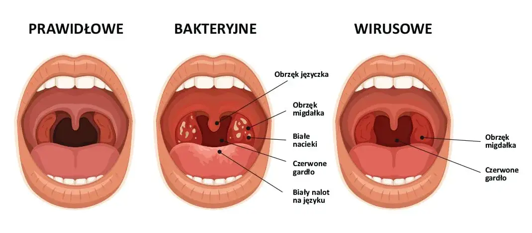 Ból gardła: Wirusy, bakterie, alergie? Poznaj prawdziwe powody!