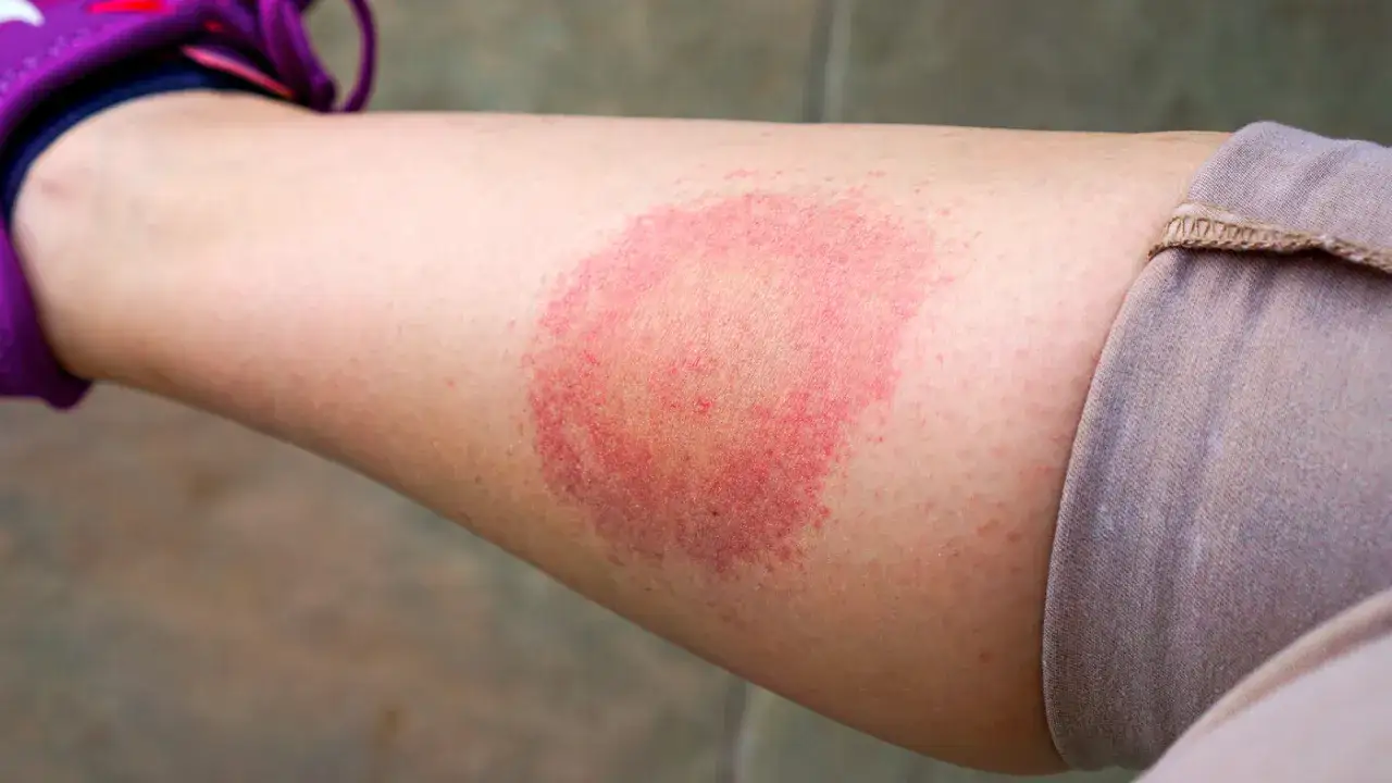 Borrelien Symptome beim Menschen: Warnzeichen, die Sie nicht ignorieren sollten