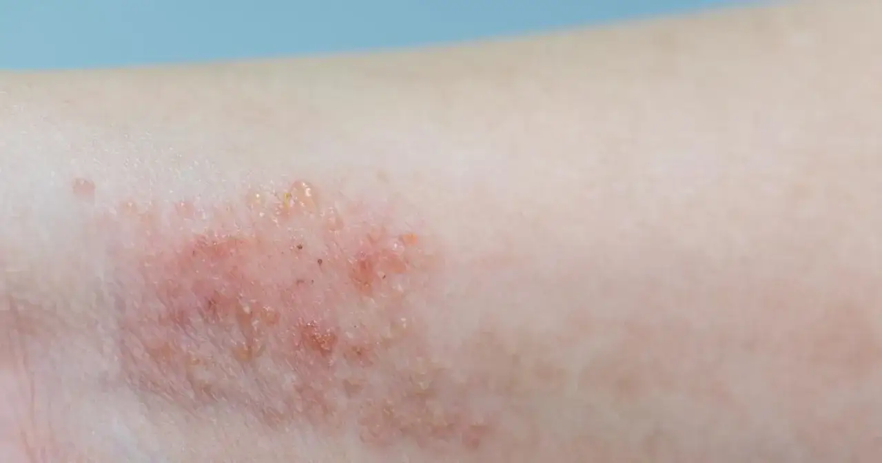 Alergia u dziecka: Jaki lek wybrać? Kiedy do lekarza?