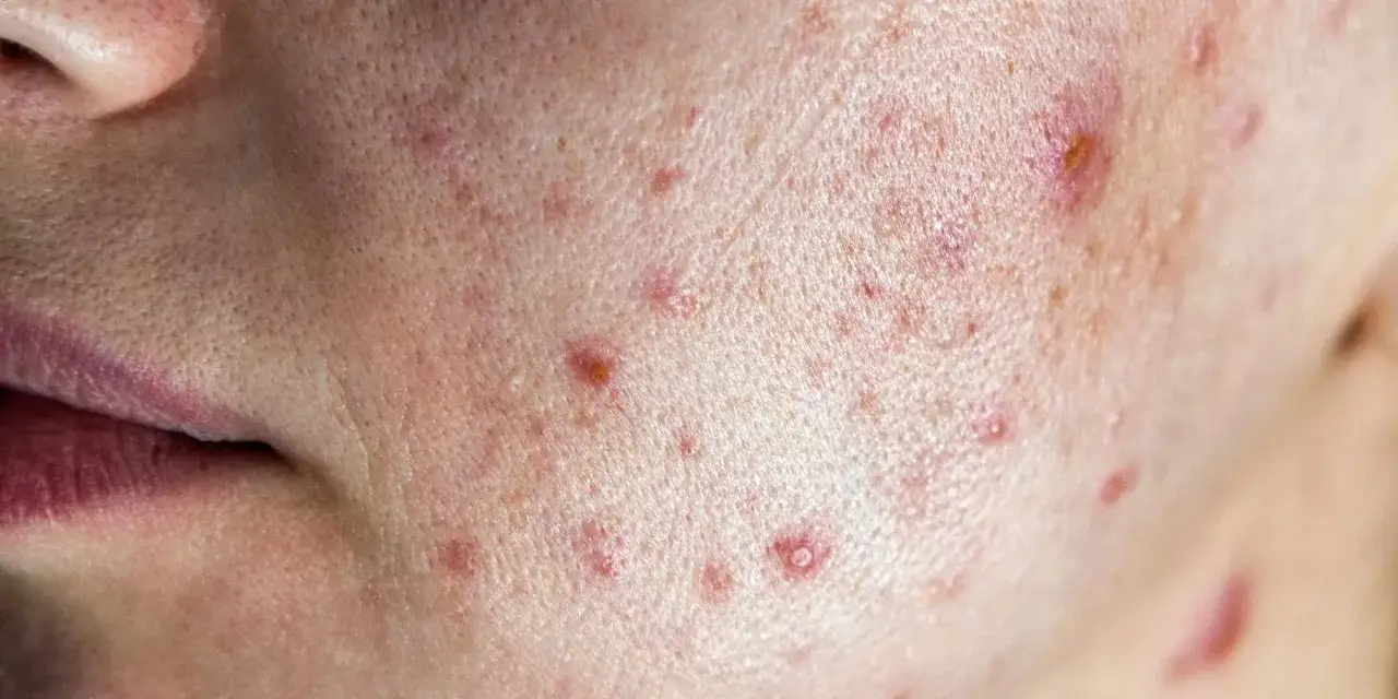 Skóra z licznymi zmianami trądzikowymi, zaczerwienieniami i wypryskami. Czy białko powoduje trądzik? To pytanie nurtuje wiele osób z problemami skórnymi.