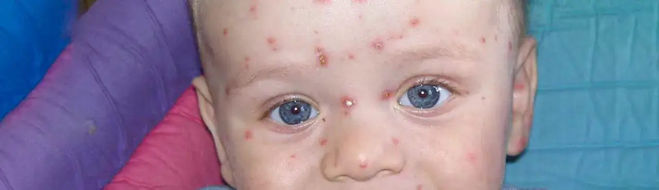 Ospa u niemowlaka – kiedy konieczna jest wizyta w szpitalu i jak reagować