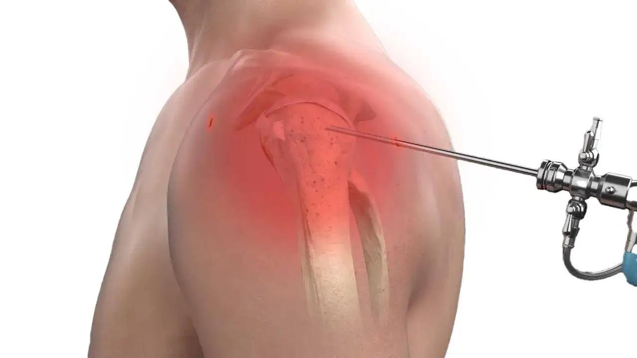 Artroskopia barku NFZ gdzie najszybciej? Sprawdź najlepsze miejsca