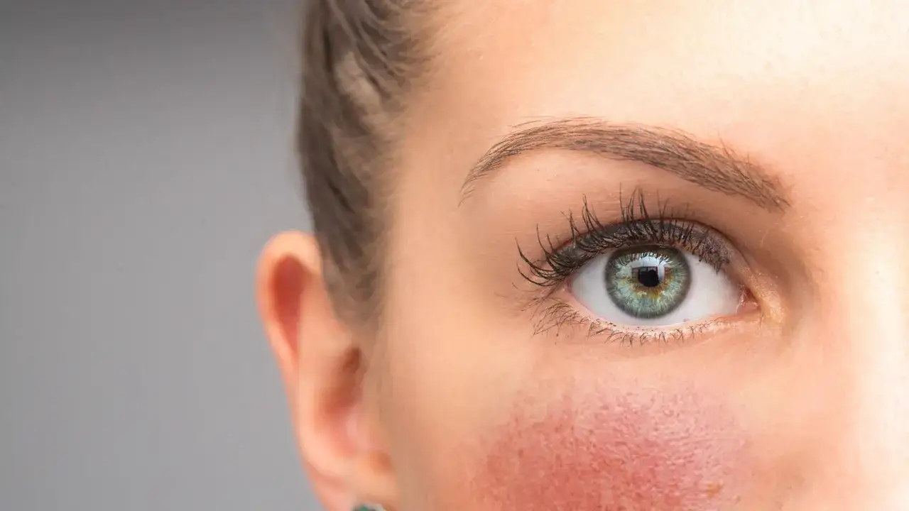 Trockene, entzündete Gesichtshaut: Der Weg zu gesunder Haut