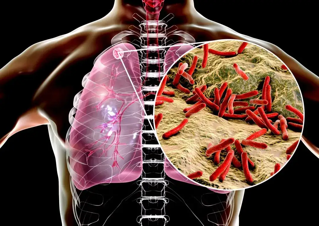 Gruźlica - co warto wiedzieć o tej chorobie?