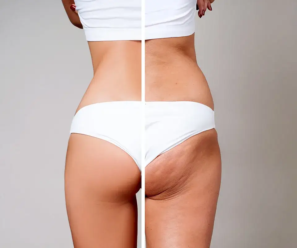 Jak pozbyłam się cellulitu: Moja kompleksowa, sprawdzona metoda