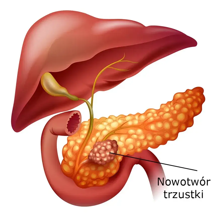 Objawy stanu zapalnego trzustki: Jak rozpoznać i uniknąć poważnych problemów?