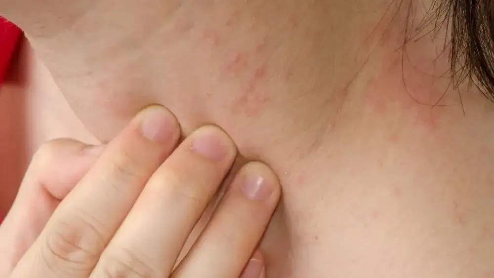 Pryszcze na szyi co oznaczają? Poznaj przyczyny i skutki zmian skórnych