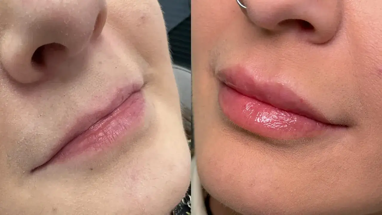 Powiększanie ust: Kwas hialuronowy, lip lift czy domowe triki?