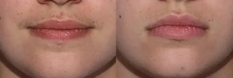 Ile kosztuje depilacja laserowa wąsika? Porównaj ceny i oferty