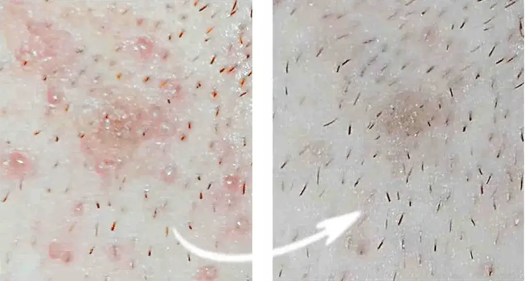 Krostki po goleniu czym smarować, aby szybko złagodzić podrażnienia