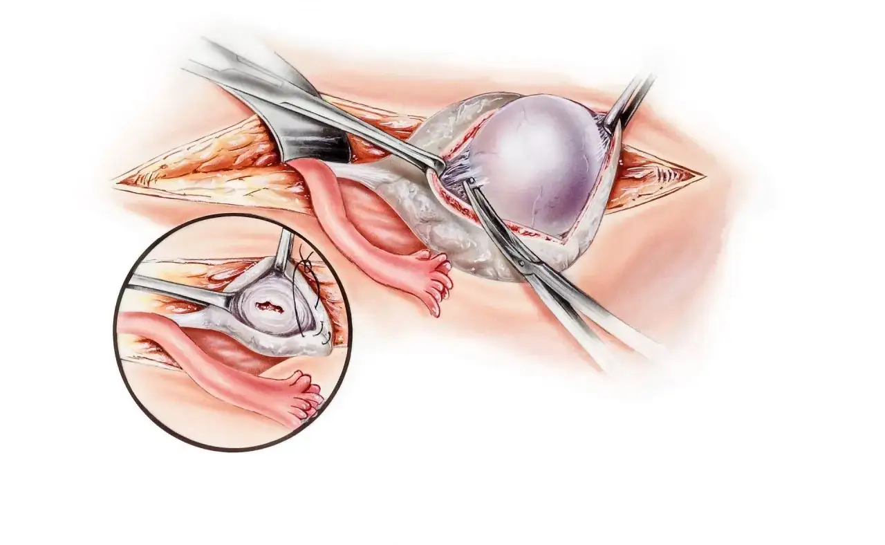 Chirurgiczne usuwanie torbieli na jajniku. Widok powiększony pokazuje szycie po zabiegu.