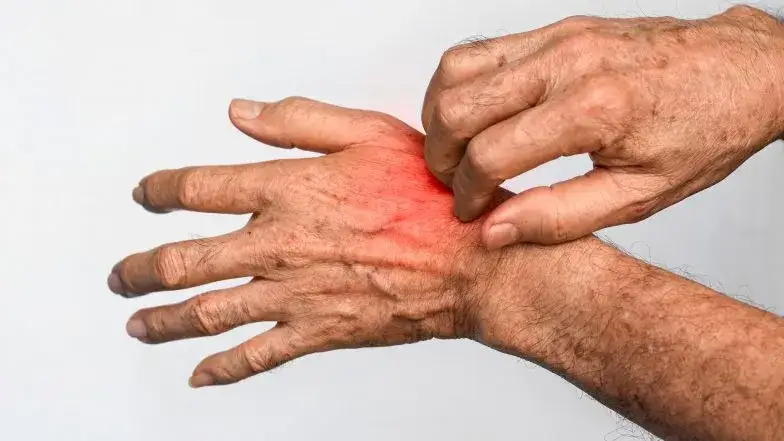 Jakie leki na świerzb bez recepty skutecznie łagodzą objawy?