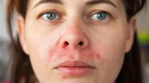 Alergia na sierść objawy skórne – jak je rozpoznać i leczyć