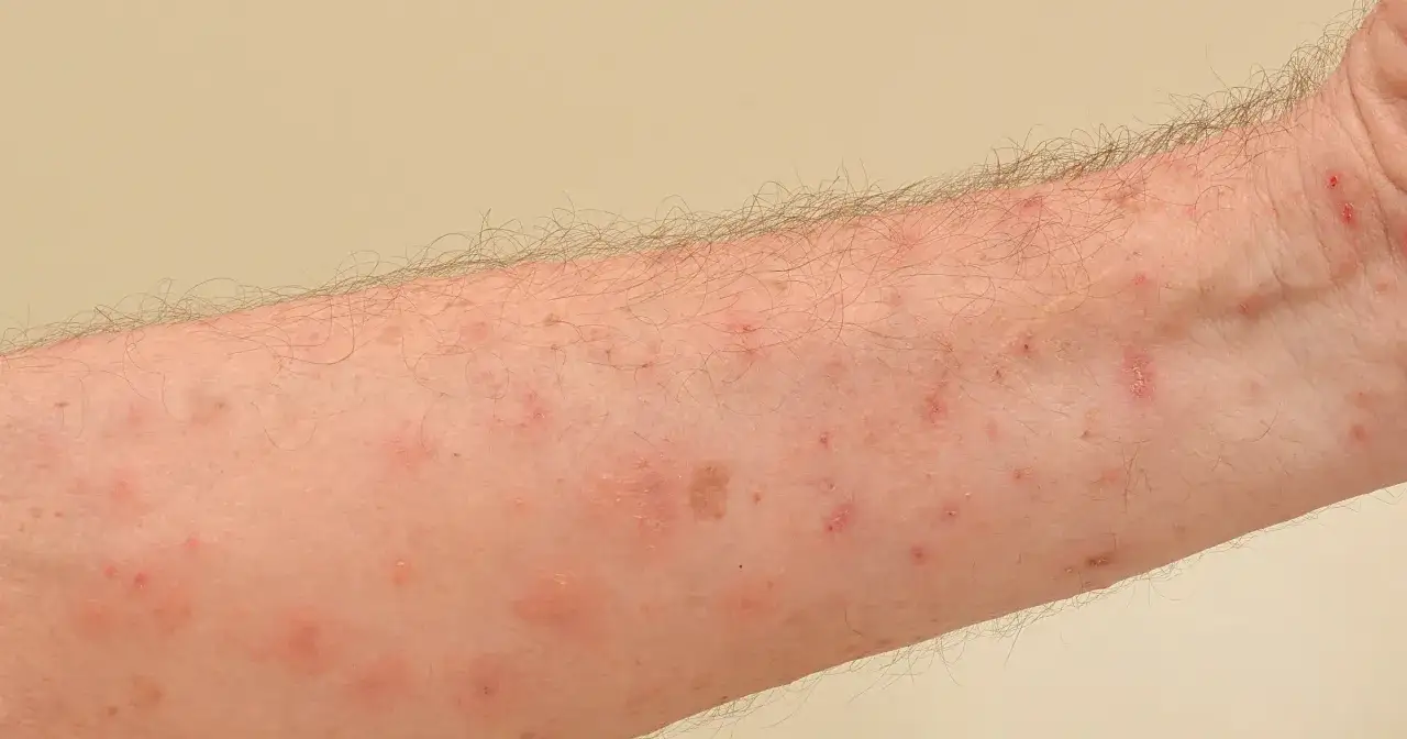 Świerzb: leki bez recepty, jak stosować i kiedy iść do lekarza