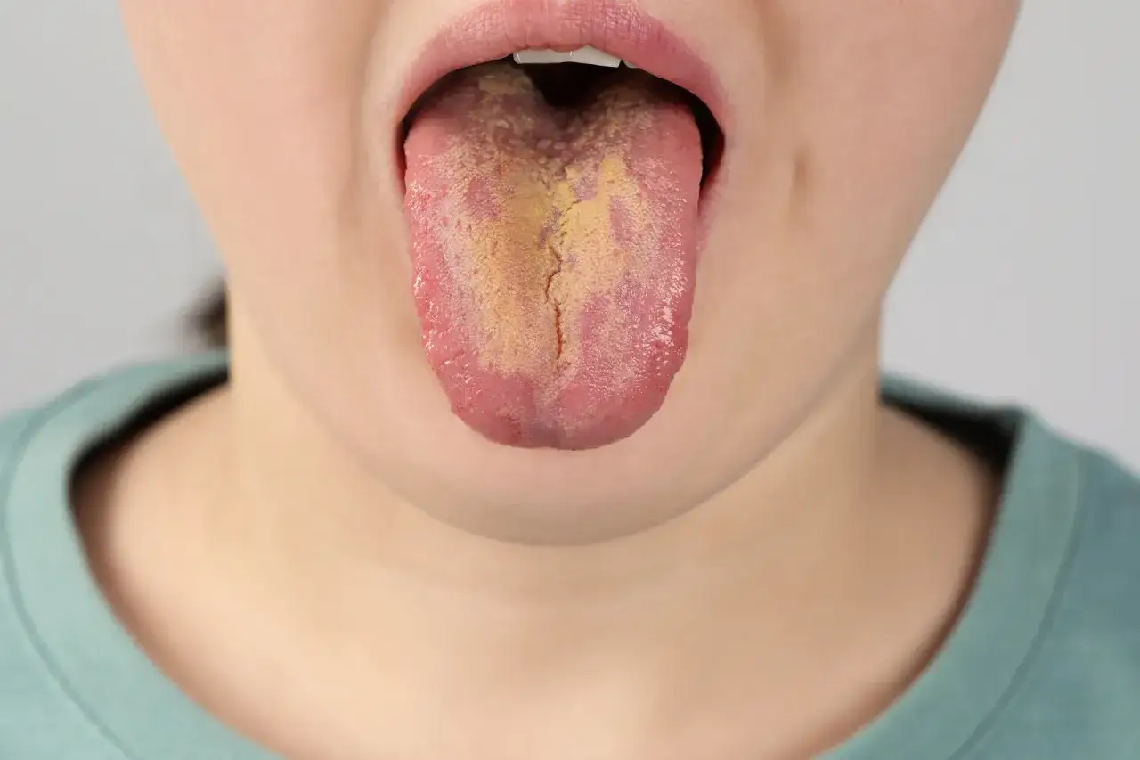 Grzybica jamy ustnej: objawy, leczenie i kiedy iść do lekarza?