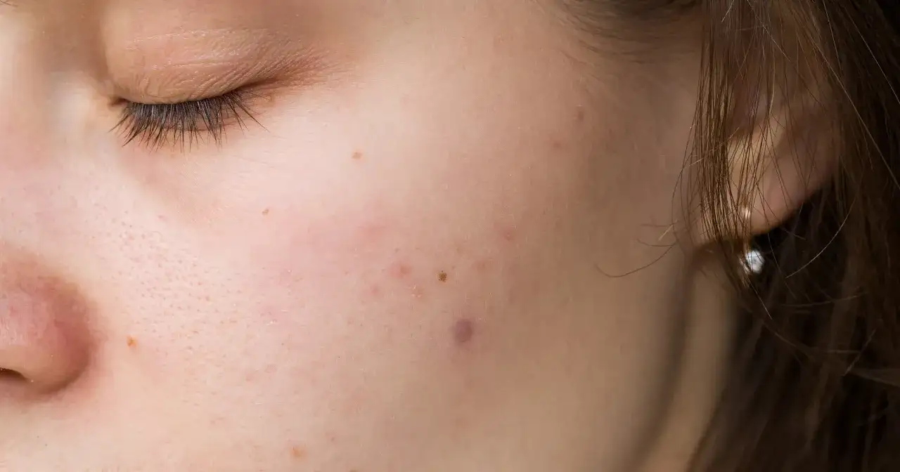 Koniec z PIE: Jak skutecznie usunąć czerwone ślady po pryszczach?