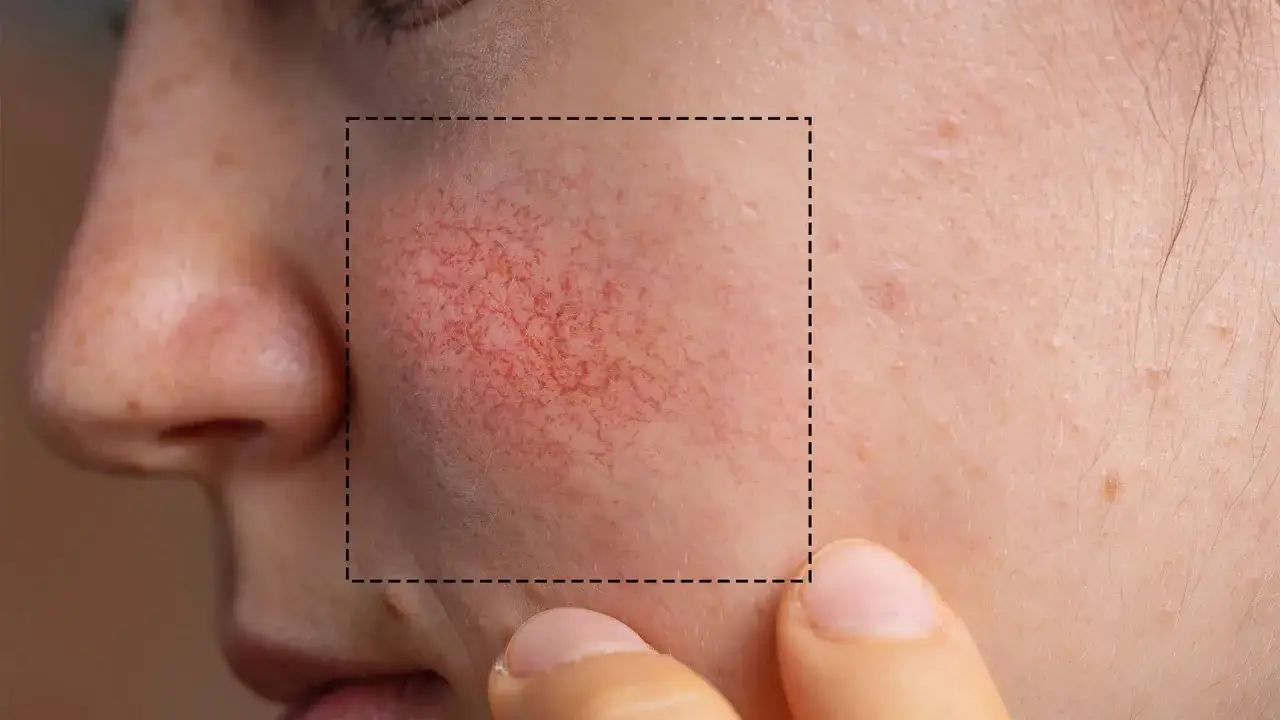 Cera naczynkowa: Jaki peeling wybrać, by nie zaszkodzić?