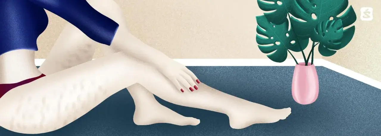 Skuteczne metody na cellulit - jak zredukować jego widoczność