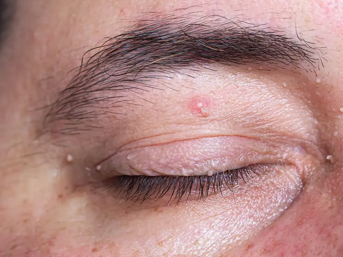 Widoczna biała kropka na powiece, otoczona innymi drobnymi zmiankami skórnymi.