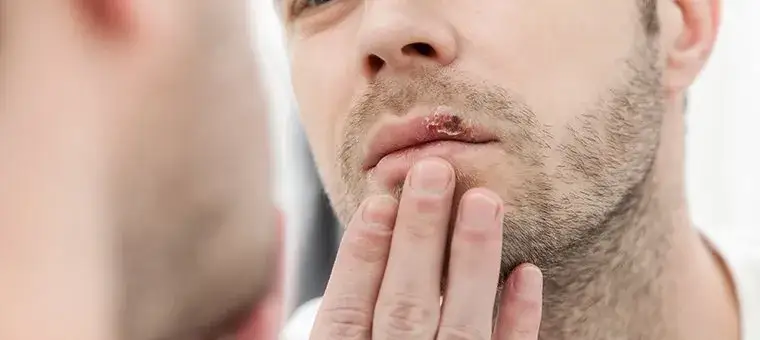 Rany w ustach? Szybka ulga i skuteczne leczenie. Porady eksperta.