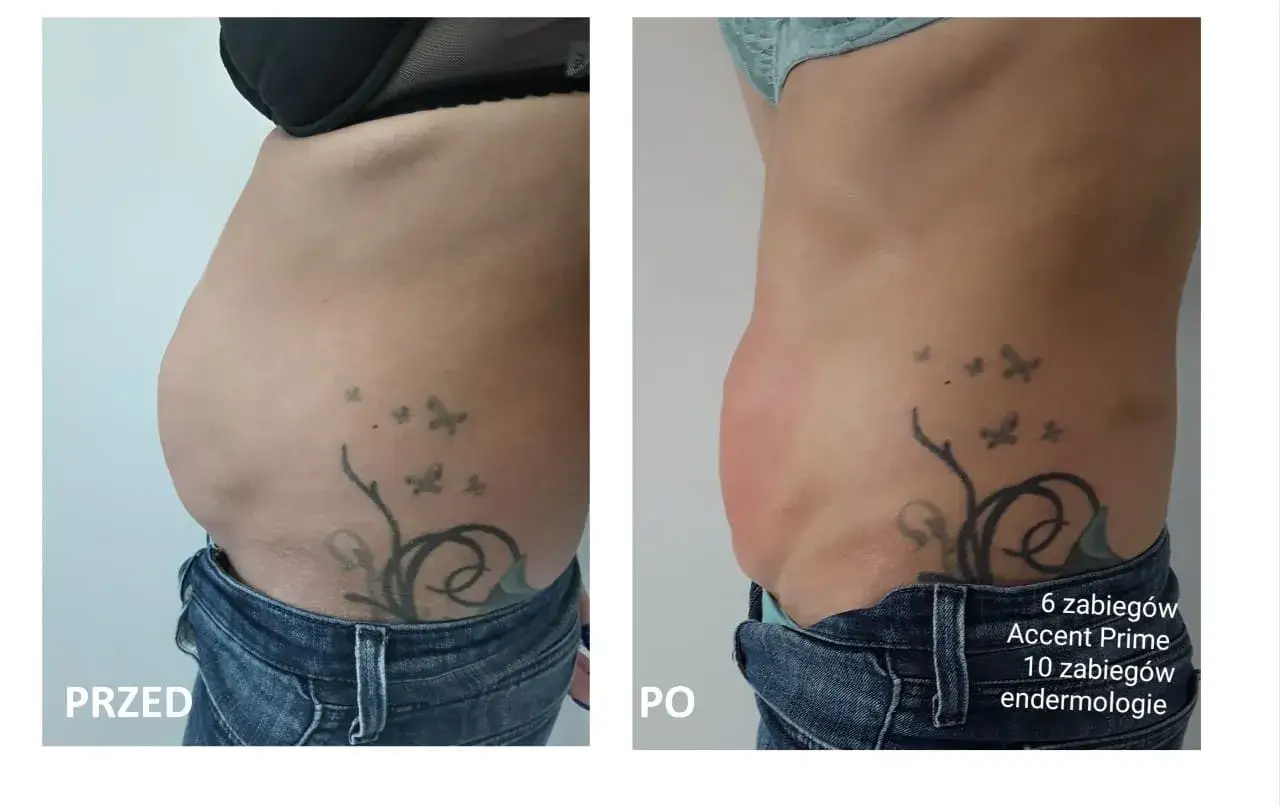 Przed i po zabiegu Accent Prime. Widoczna redukcja tkanki tłuszczowej brzucha, co pokazuje skuteczność liposukcji kawitacyjnej.
