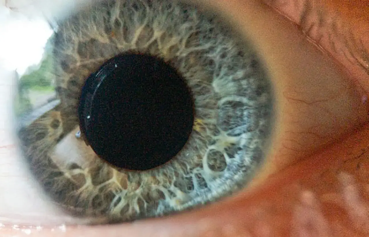 Jak szybko postępuje jaskra i jak uniknąć utraty wzroku