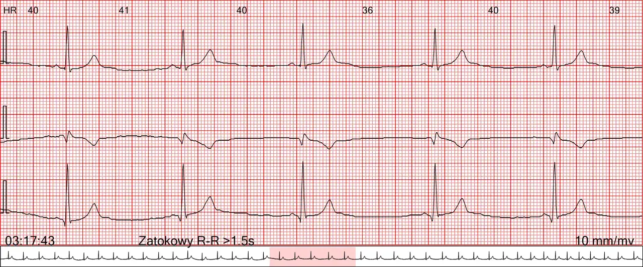 EKG z zapisem rytmu zatokowego. Widoczne są fale serca z zaznaczonymi odstępami R-R >1.5s, wskazującymi na bradykardię.