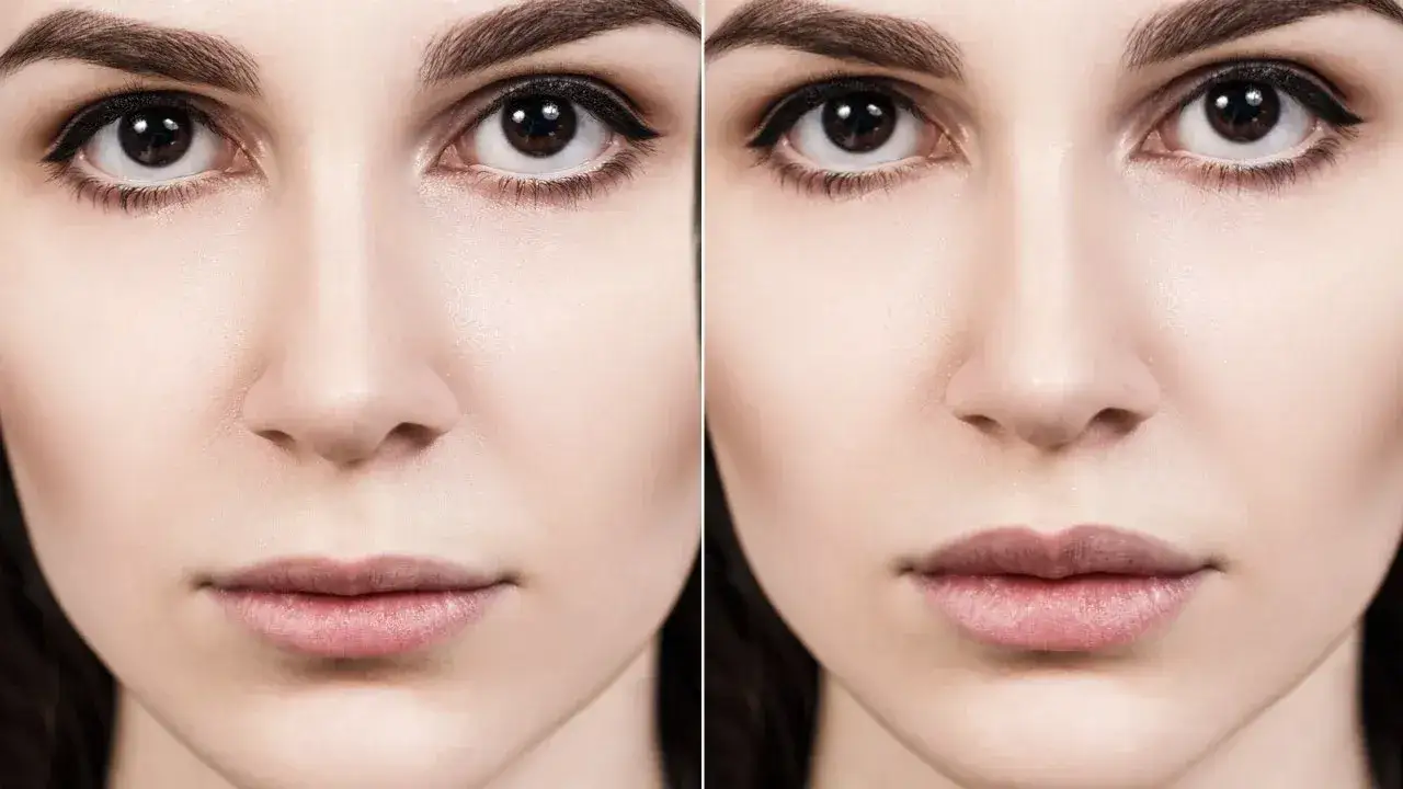 Usta: botoks czy kwas hialuronowy - co wybrać dla idealnego efektu?